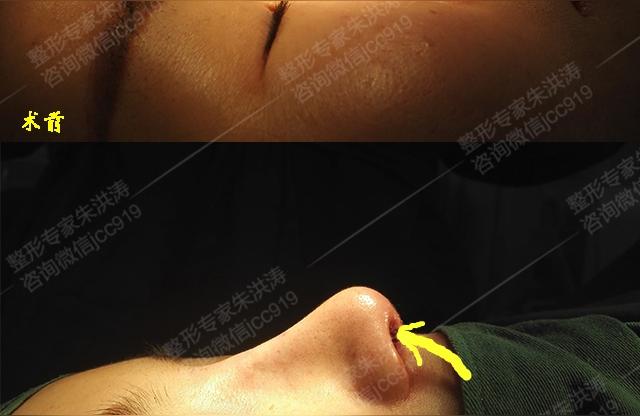 鼻翼變短視頻教程鼻子怎么變小 運營百科