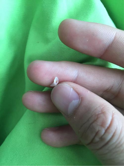 梦境解析，昨天梦见自己牙齿脱落——寓意与解读