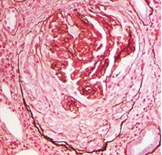 aso结果398需要服药吗 aso结果444正常吗