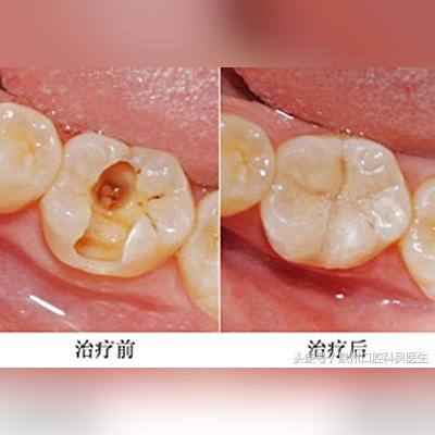 泉州市哪里补牙便宜些的长尾关键词有哪些