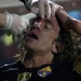 足球运动员脸部骨折赔偿的长尾关键词有什么