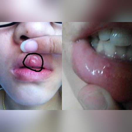 天气冷嘴巴起泡了怎么办