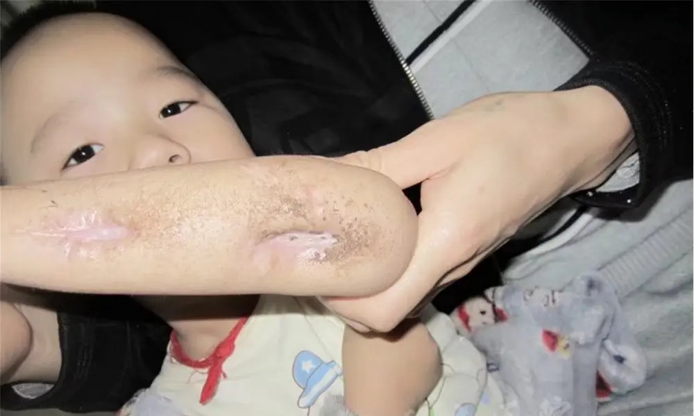 引流条是管吗 引流条是纱布吗