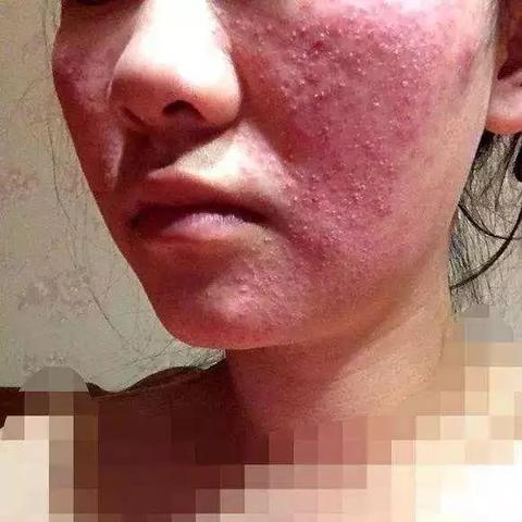 揭露激素护肤品微商骗局的长尾关键词有哪些