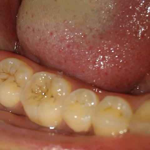 无锡市口腔补牙价格的长尾关键词有哪些