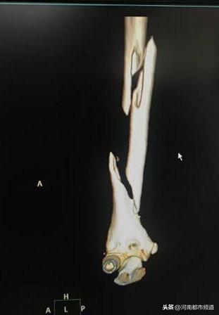 男孩为拍短视频，把手伸进洗衣机！右上臂骨绞成“三节棍”