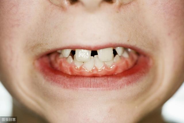 孩子刚换的牙就是歪的怎么办