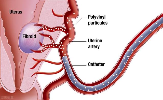 子宫肌瘤剖腹产时可以摘除吗