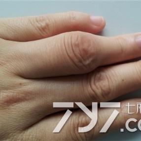 关节炎是什么症状