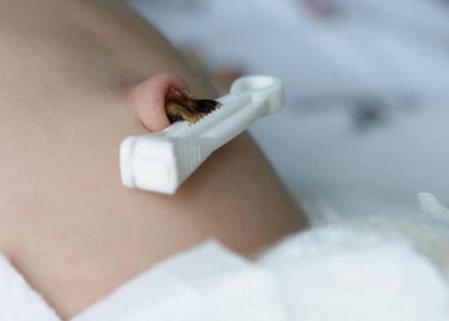 宝宝肚脐出现什么症状