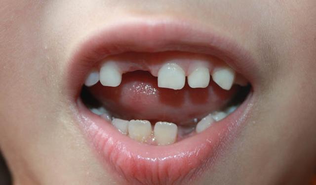 孩子牙齿变黄可以预防吗宝宝牙齿变黄可以改善吗