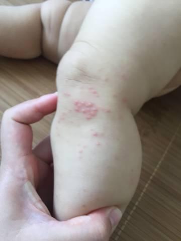 孩子总被蚊子咬是怎么办