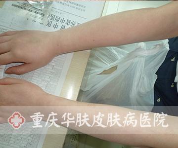 慢性荨麻疹可以根治吗