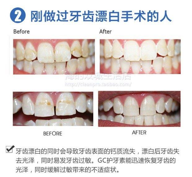 孩子牙齿有白斑是怎么回事