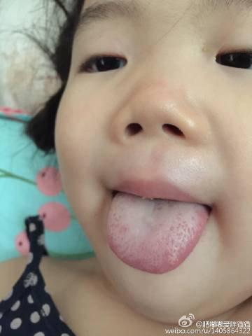小儿草莓舌是什么病
