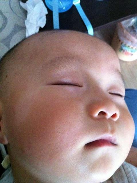 孩子肚子里有虫脸上是会有白斑吗