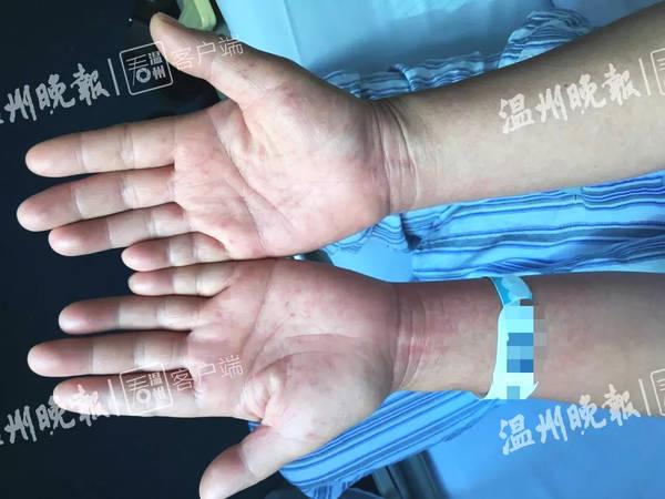 宝宝发高烧时要注意眼睛护理