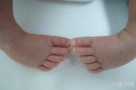 宝宝足内翻怎么办