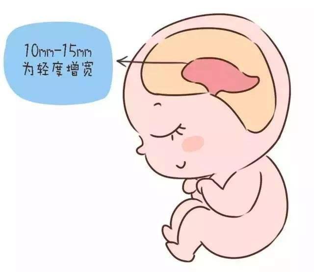 新生儿侧脑室增宽有什么影响