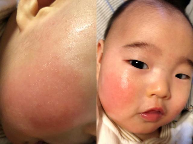 小孩得了口水疹怎么办