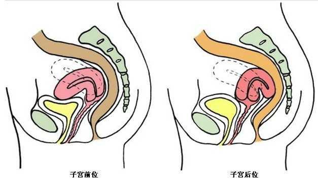 子宫后位会有什么影响,需要治疗吗