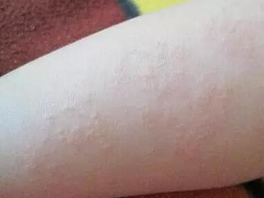 宝宝湿疹和热疹怎么区别