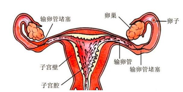 宫外孕 切除一侧输卵管