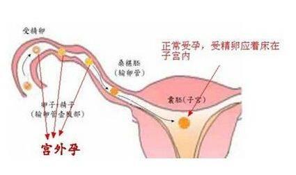 宫外孕的初期症状