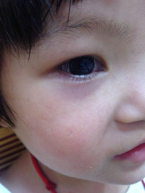 孩子眼睛有眼屎多怎么回事