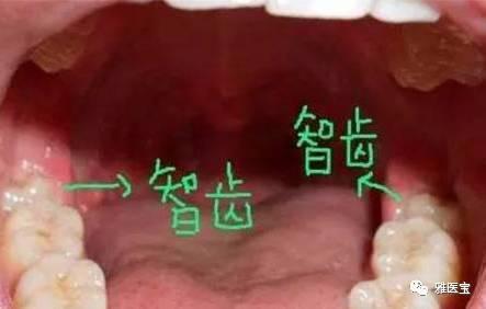 智齿是如何自己拔出来的