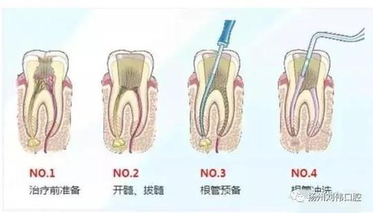 对于那些牙髓炎,牙髓坏死,各种类型的根尖周炎都适于作根管治疗,包括