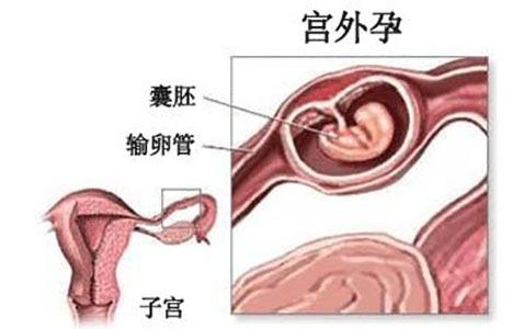 准妈妈如何避免异位妊娠