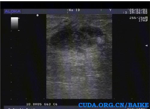 哺乳期急性乳腺炎的治疗