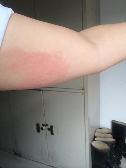 婴儿湿疹可以用好孩子药膏吗