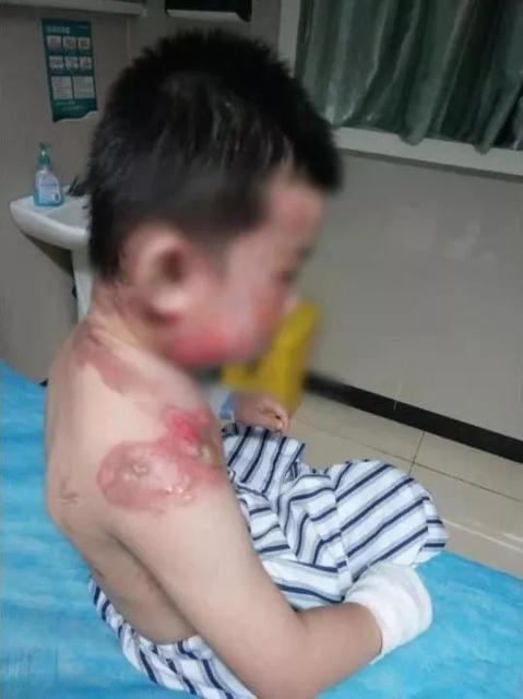 宝宝烫伤怎么办处理