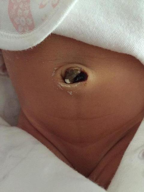 新生儿肚脐出血怎么护理视频