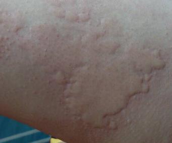 孩子荨麻疹是什么原因引起的