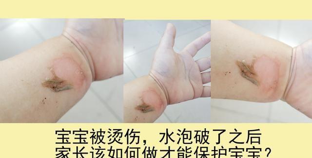 如果孩子被烫伤了怎么办