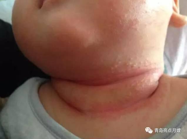 宝宝淹脖子破皮怎么办