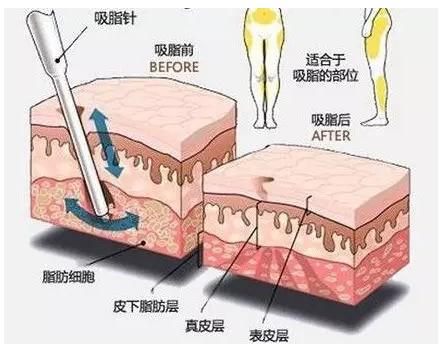 抽脂手术减肥好不好