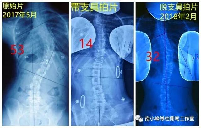 孩子脊柱侧弯是怎么引起的