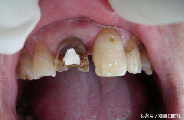 蛀牙的危害有哪些