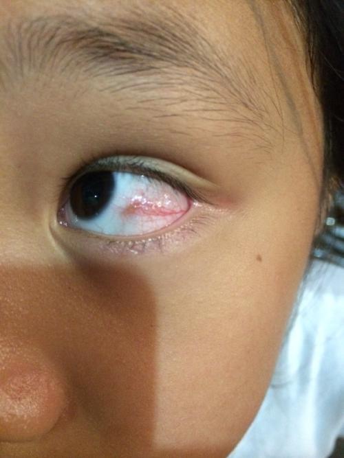 小孩子眼睛红