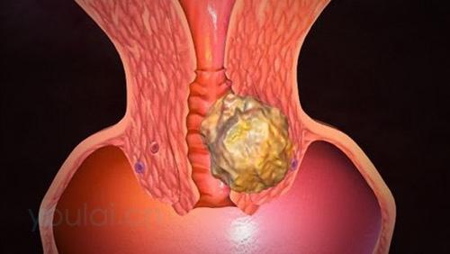 哪些人容易患宫颈癌?