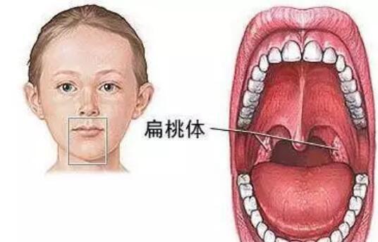 小孩经常扁桃体发炎是怎么回事小孩子经常扁桃体发炎是怎么回事