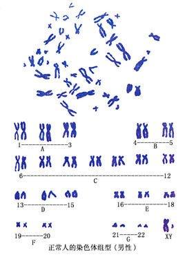 胎儿发生染色体异常是怎么回事