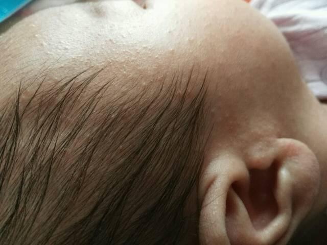 新生儿痤疮和新生儿湿疹区别