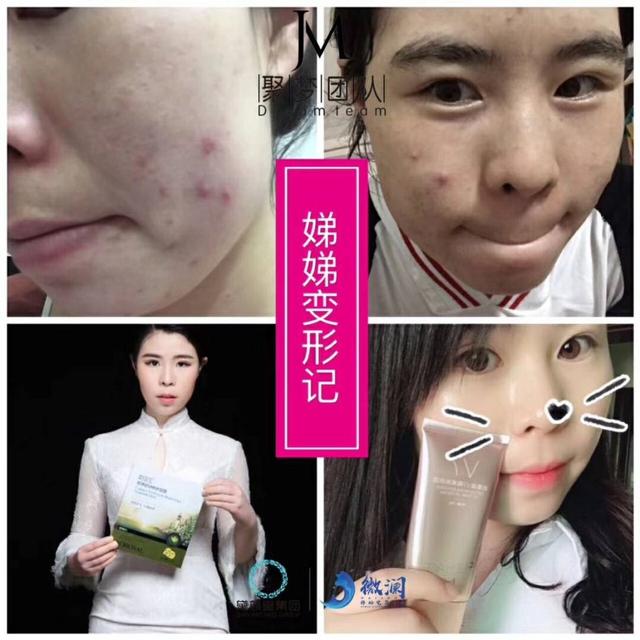 脸部红血丝能治好吗