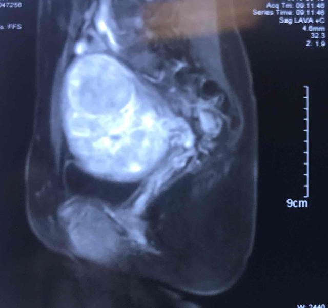 怀孕出现子宫肌瘤怎么办呢