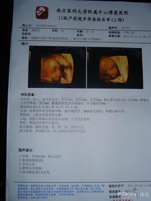 彩超是否能看出胎儿畸形